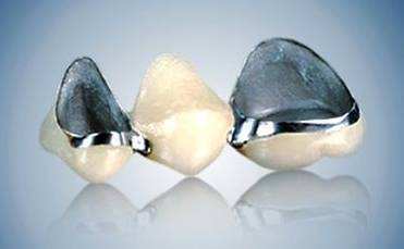 全瓷牙 全瓷牙又称全瓷冠,是 覆盖全部牙冠表面,且 不含金属内冠的瓷
