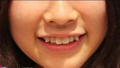 为啥要拔虎牙 3a5f8edfb8b8457cb6cc364bdb58fae0.jpeg