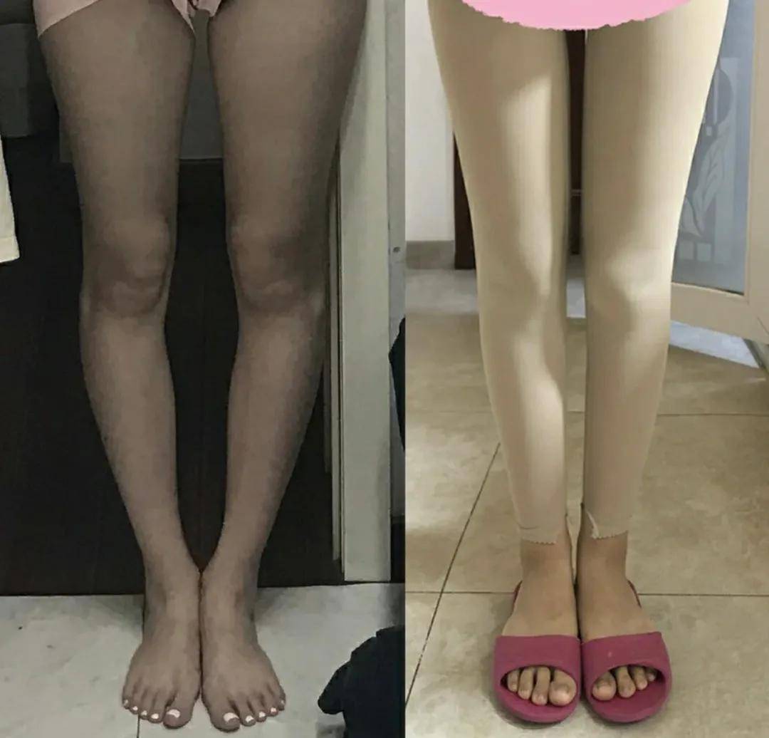 手术|杨幂关晓彤杠上了？撞衫尴尬就算了，还被网友喷做了直腿手术…