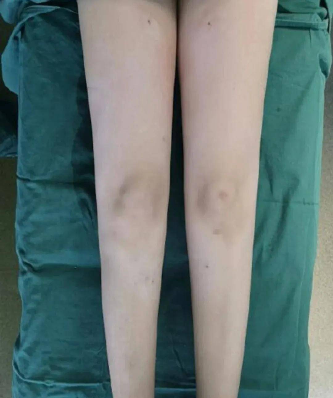 手术|杨幂关晓彤杠上了？撞衫尴尬就算了，还被网友喷做了直腿手术…