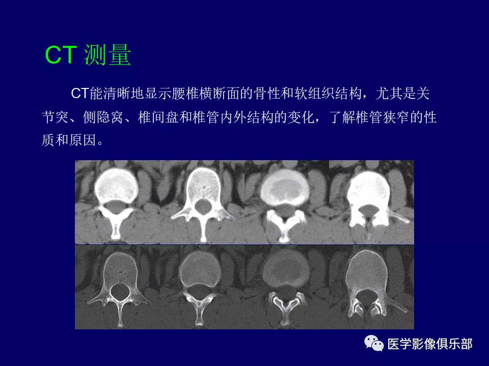 腰椎结核的ct诊断与鉴别