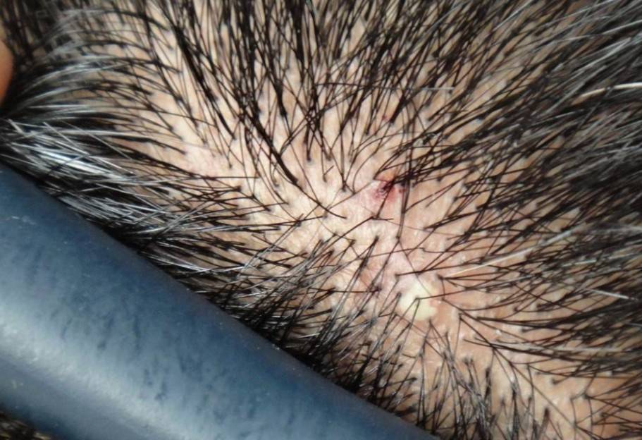 毛囊皮脂腺萎缩甚至破坏,从而造成愈合后遗留疤痕的脱发性毛囊炎