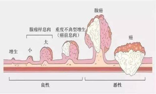 进行|息肉切了，就万事大吉？做不到3点，很难安心