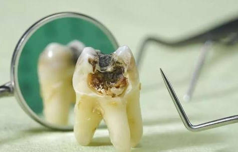 牙髓炎导致的牙齿神经疼,拔牙?根管治疗?究竟需要怎样