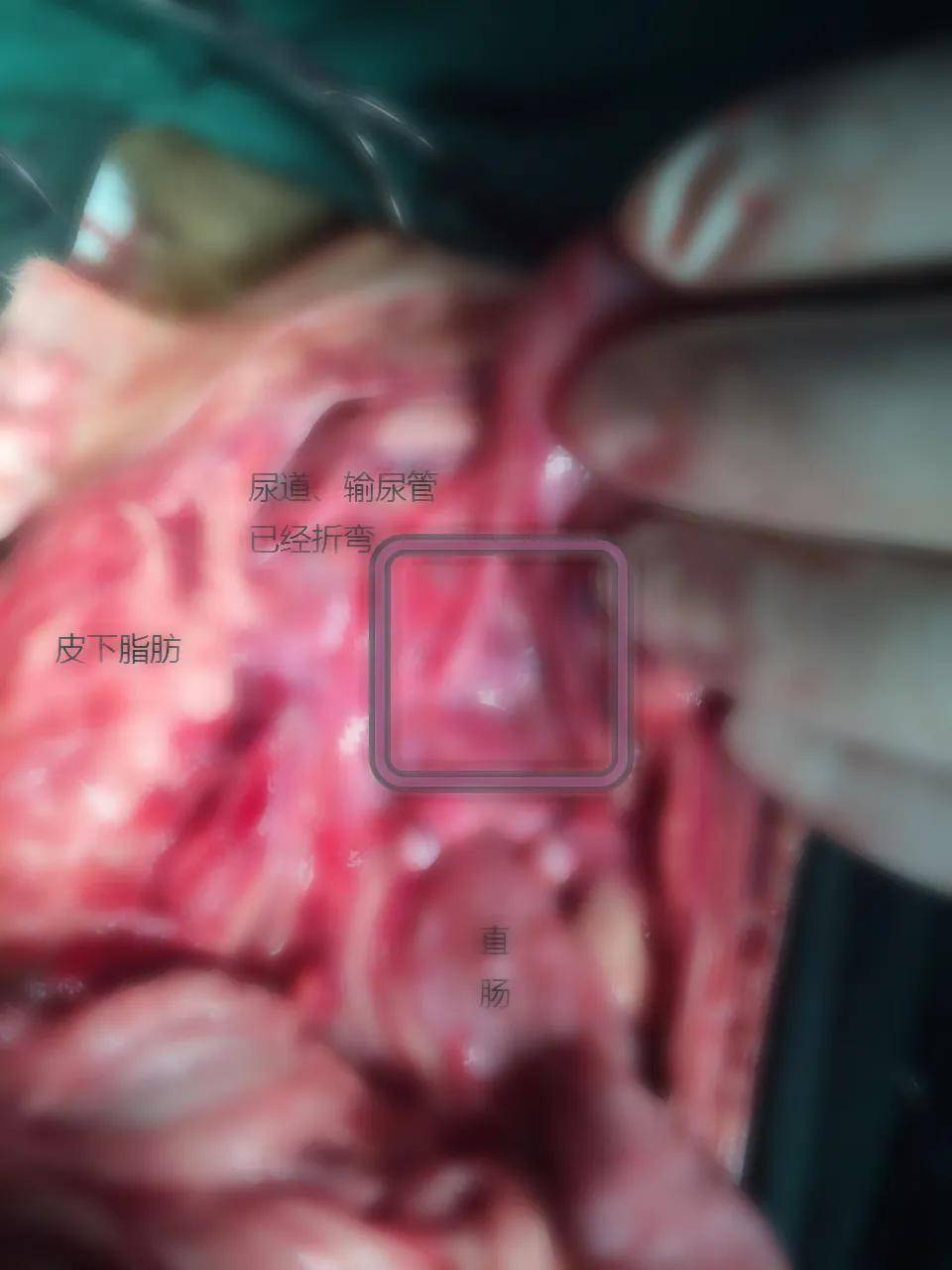 膀胱与疝轮已经黏连,尿道,输卵管均折弯.