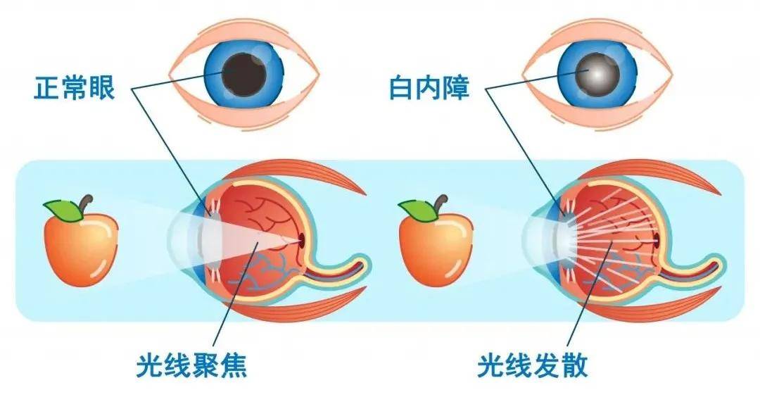 皮质性白内障的一个特点,即晶状体是 从边上逐渐向中间浑浊的,看上去