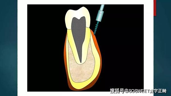 牙齿矫正支抗钉植入引起的常见并发症及处理方法