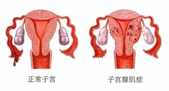 诊断|子宫腺肌症怎么检查？