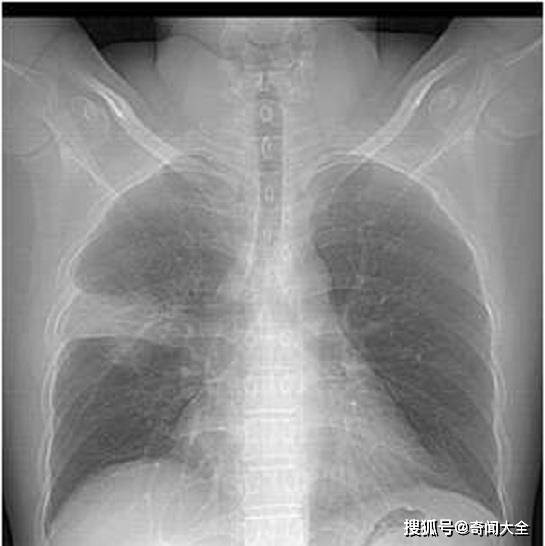主要是还是病变范围扩大和融合造成双肺实变甚至纤维化