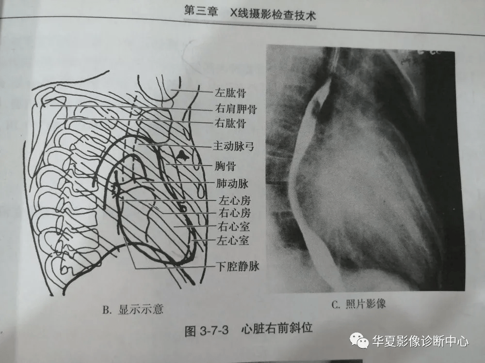 心脏右前斜位(被检者立于摄影架前,面向摄影架,右前胸壁紧贴摄影架