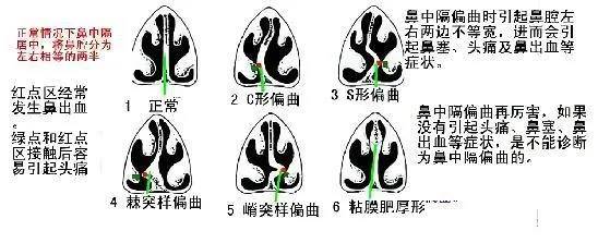 中隔偏向一侧,就会使一侧鼻腔狭窄,对侧鼻腔宽大,导致对侧下鼻甲代偿