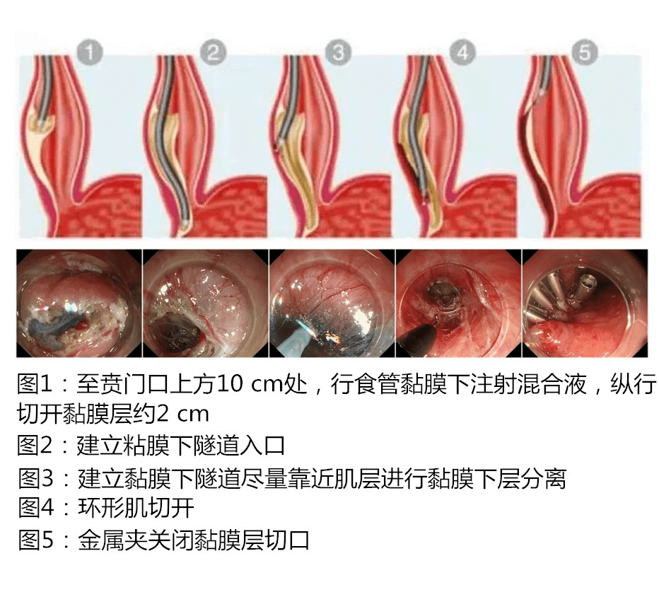 食道内巧开"隧道",这种手术也是神了!