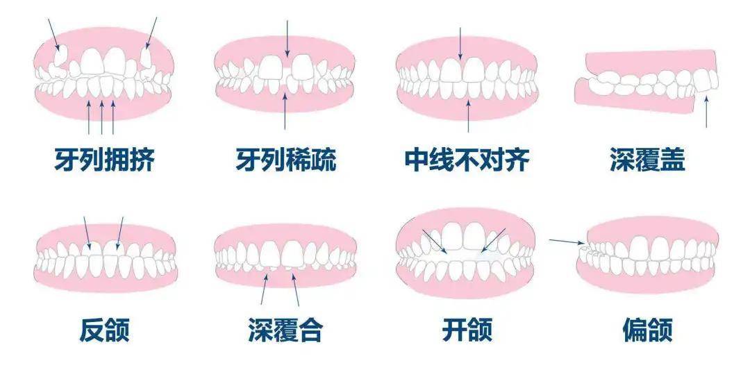 你真的了解你的牙齿咬合吗?四个小动作,检查出你的牙列是否正常_影响