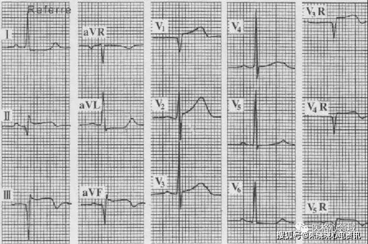 心肌梗死的定位诊断及相关心电图表现_冠状动脉