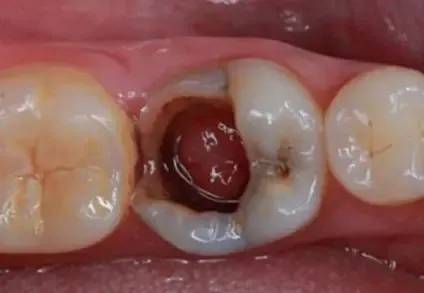 干货:牙髓息肉的治疗方法值得收藏!_牙髓炎