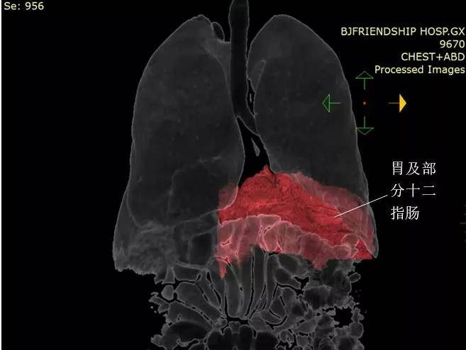 食管|“胸腔胃”—— 一块压在患者心上的大石头