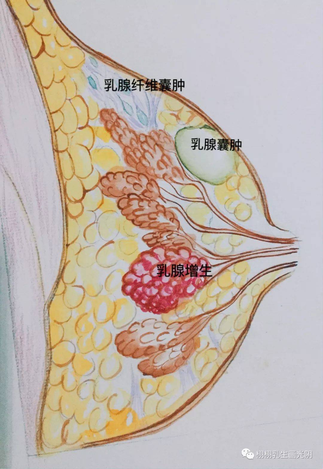 带你走进乳房手绘水彩图解乳房良性疾病