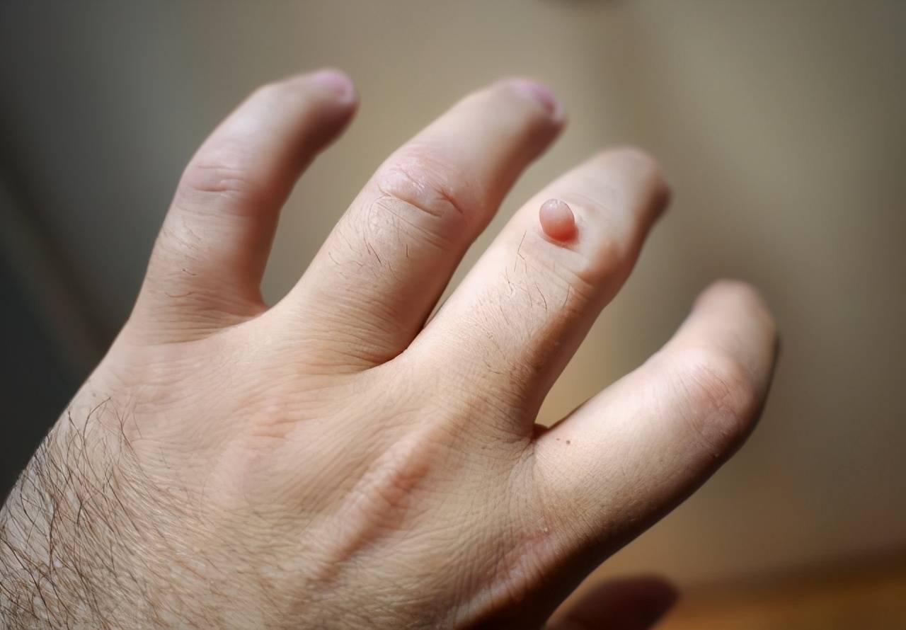 总是找上中老年人的 小肉球 ,是怎么回事