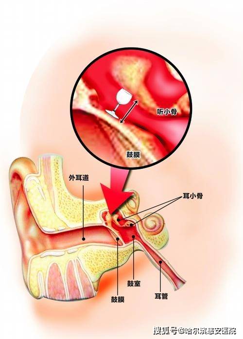 【科普】听小骨创伤_手机搜狐网