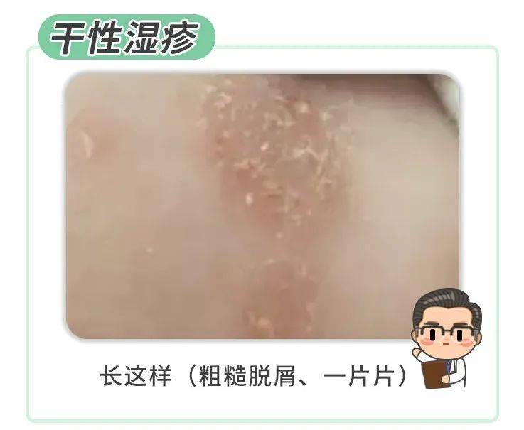 激素|再贵的药也没用药监局点名！湿疹宝宝霜含禁用成分！这点做不好