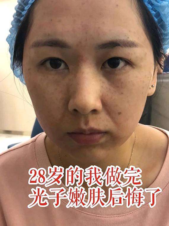 28岁的我做完光子嫩肤后悔了!