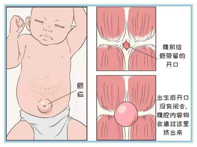 【婴儿脐疝】婴儿脐疝的症状_婴儿脐疝怎么办