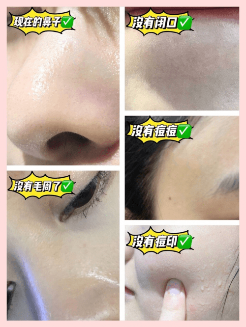 用什么方法可以打开毛孔 70fd77a0069e4f7dbf7d53f309bf9ec9.png