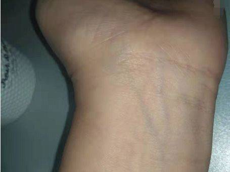 腕横纹线处有青筋,通常在提示妇科疾病,妇科病如月经不调,带下病,痛经