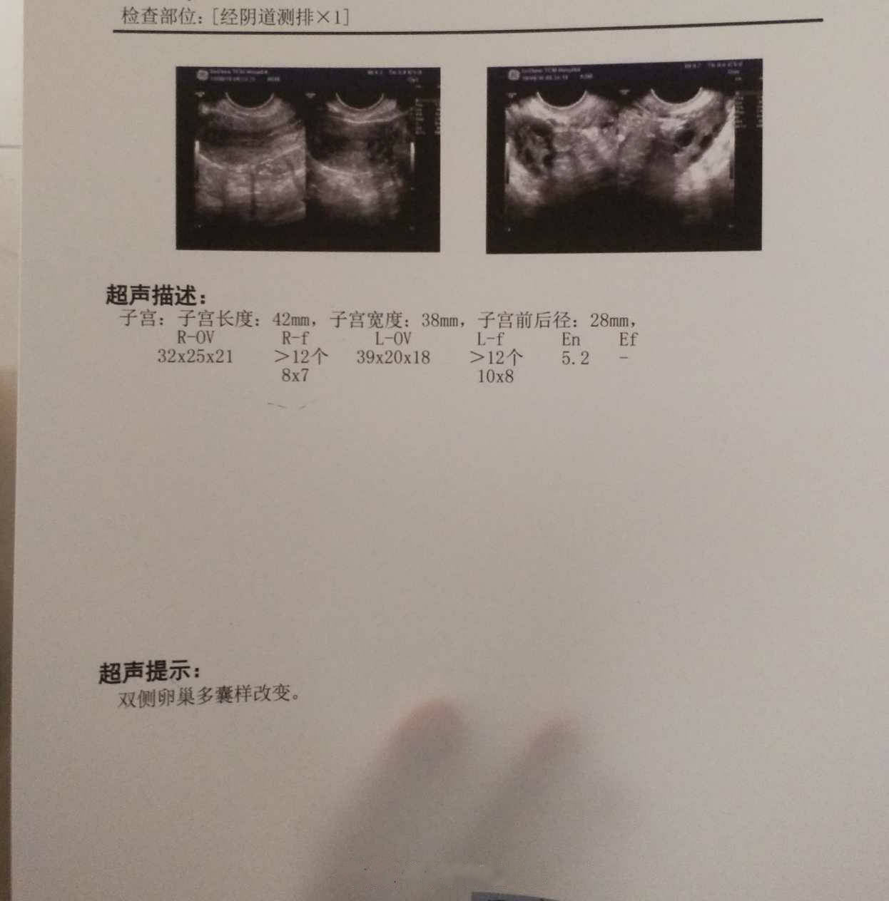 多囊人口渴_多囊卵巢的人不容易老(2)