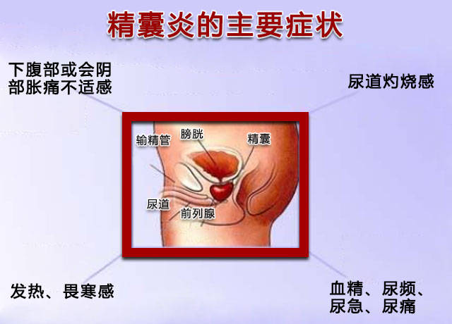 精囊炎的主要症状是什么?看一看中医辩证分型论治精囊炎!_手机搜狐网