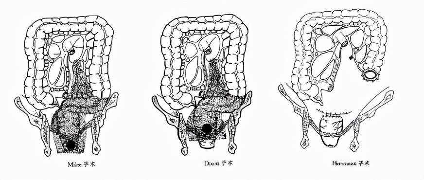 结肠暂时性造口(hartmann): 适用于直肠癌伴急性肠梗阻 c.