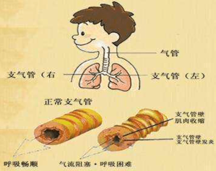 至爱方健康大讲堂支气管炎患者难挨季节已到适当补硒呵护你的肺