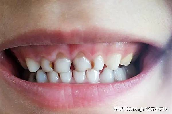 怎么才能让牙齿不长蛀牙 e8f3256f5b244d9b92994e8c0d32c994.jpeg