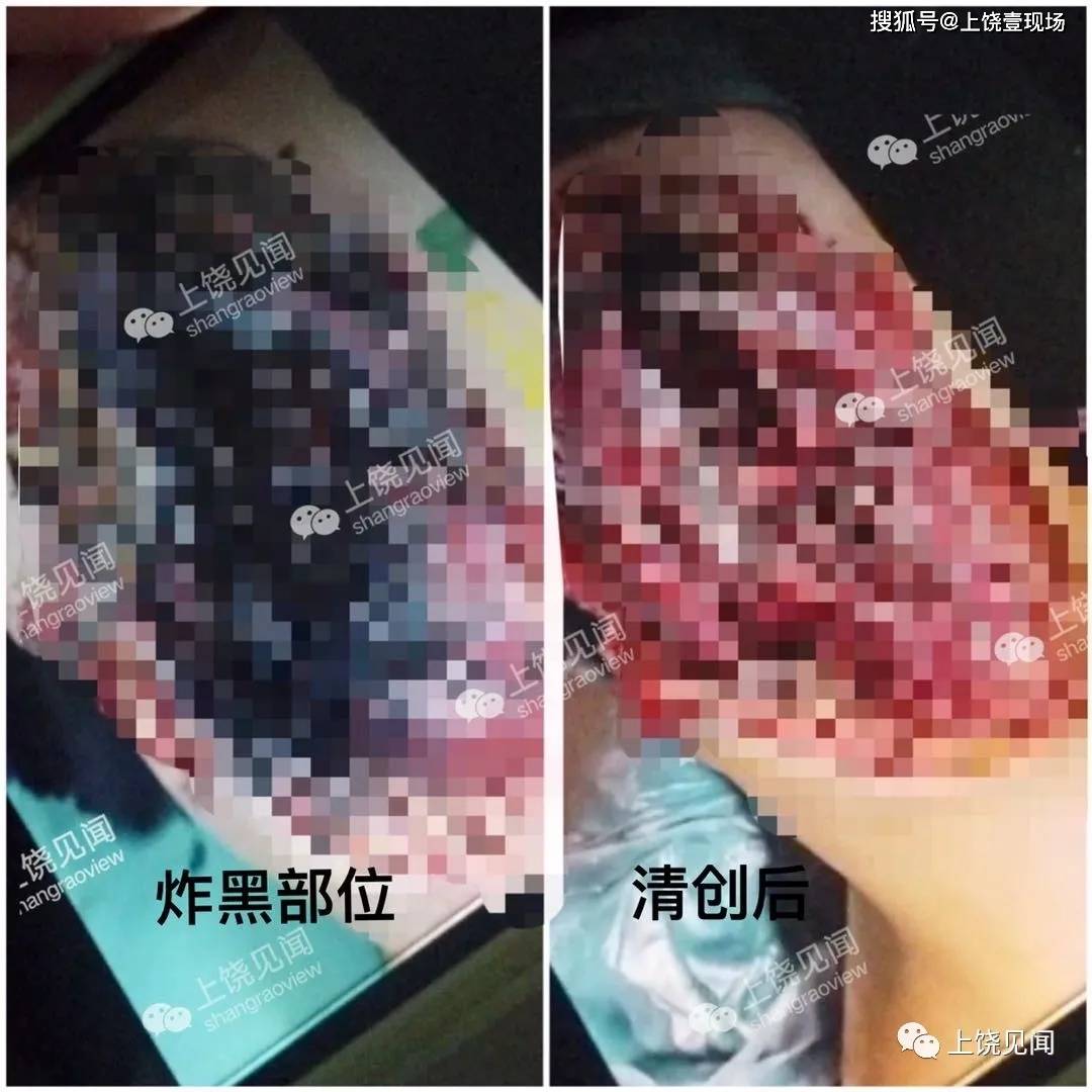 小孩大腿炸得很厉害,骨头都炸黑了,炸得很深,血管,肌肉,神经都炸黑了