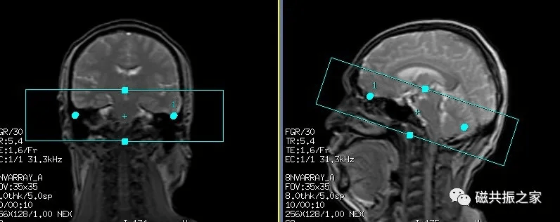 磁共振(mri)内耳扫描技术