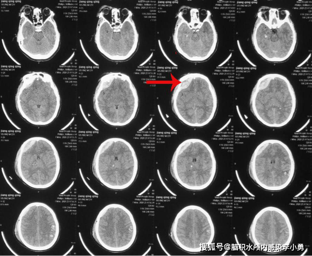 图-2)示右额叶硬膜外血肿,左顶叶脑挫裂伤