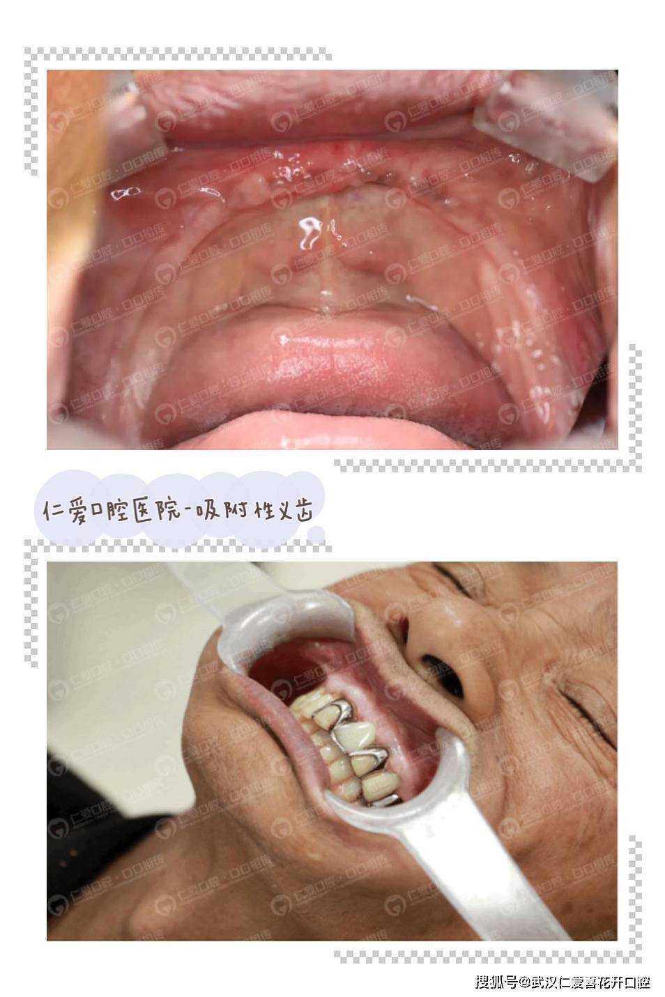 这位王爷爷今年70岁,上半口牙缺了四年,一直戴着活动假牙,每次吃饭都