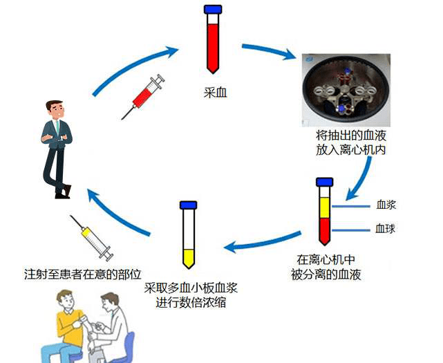 富血小板血浆prp再生修复新篇章