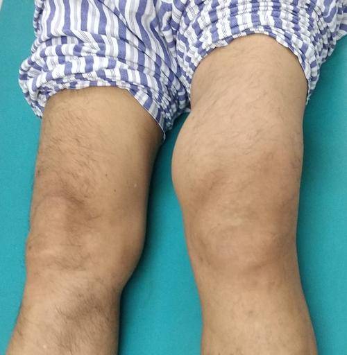 膝关节肿胀积液膝关节滑膜炎应该如何应对