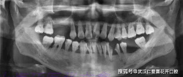 实拍牙周病发展过程，你还敢说可以忽视吗