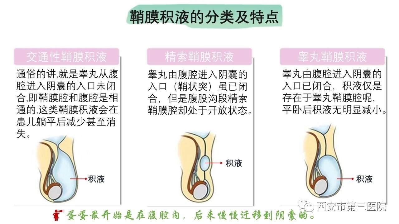 【肿大的蛋蛋】之鞘膜积液