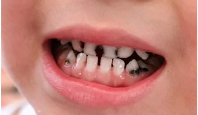 孩子龋齿要不要治疗,等新牙顶掉还是必须看牙医?