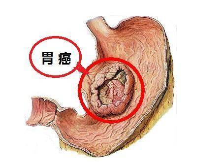 脾胃专家张美莲谈胃癌癌前病变不应坐等加重中医辨证阻断肠化传变