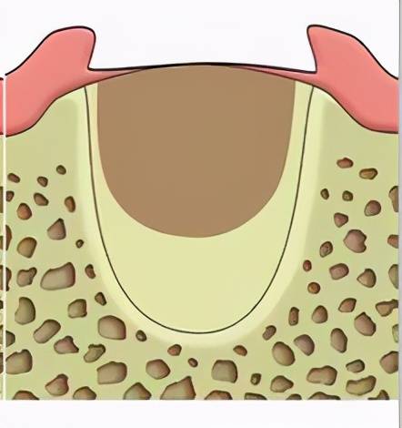 原始的纤维样骨替代结缔组织拔牙后3～4天,上皮自牙龈缘开始向血凝块