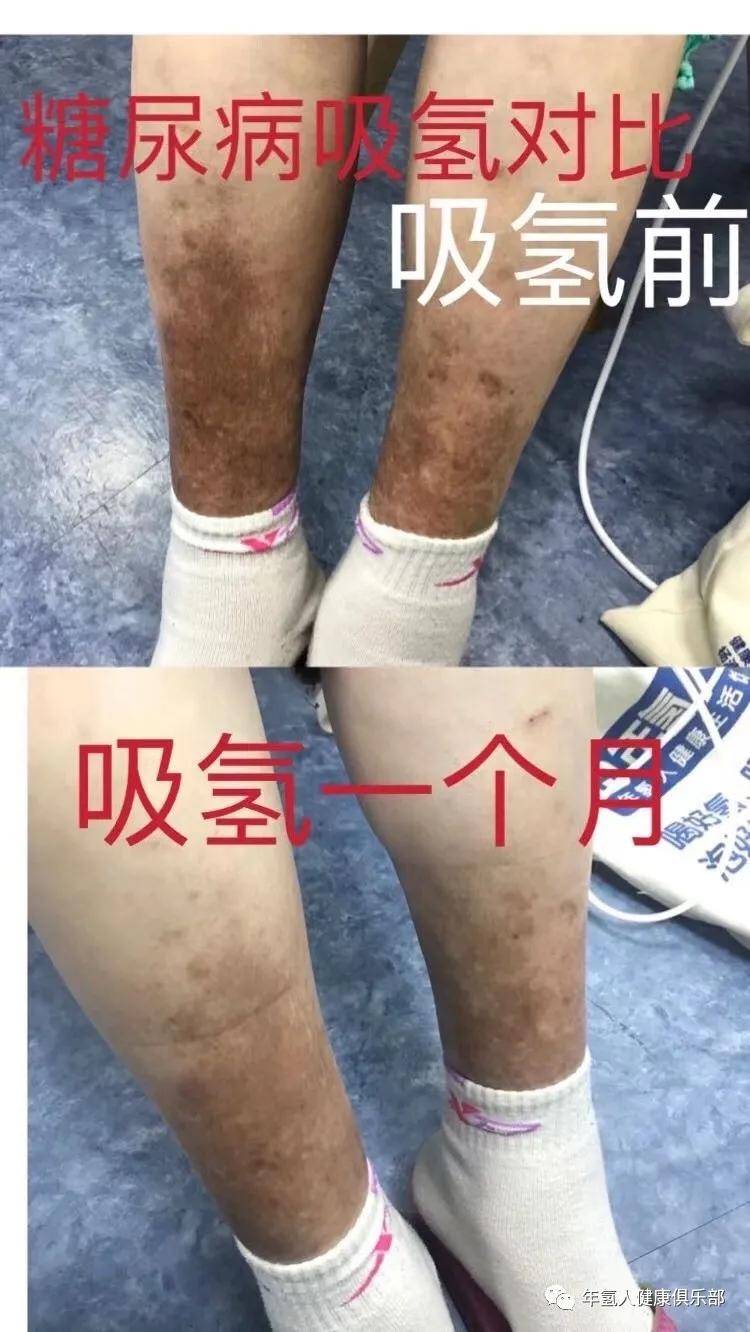 来看看糖尿病人吸氢后发生的这些神奇