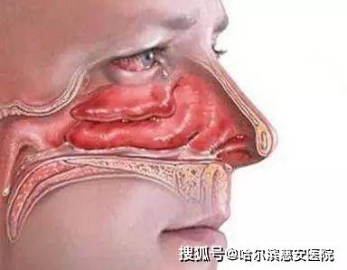 【科普】鼻血管瘤