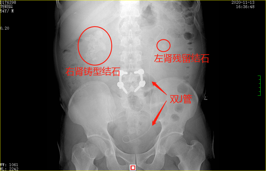 双肾结石取石失败,他体内带管苦等6个月无果!