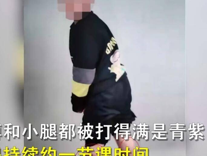 老师便用凳子腿和钢丝锁反复抽打孩子,胳膊和小腿都被打得满是青紫