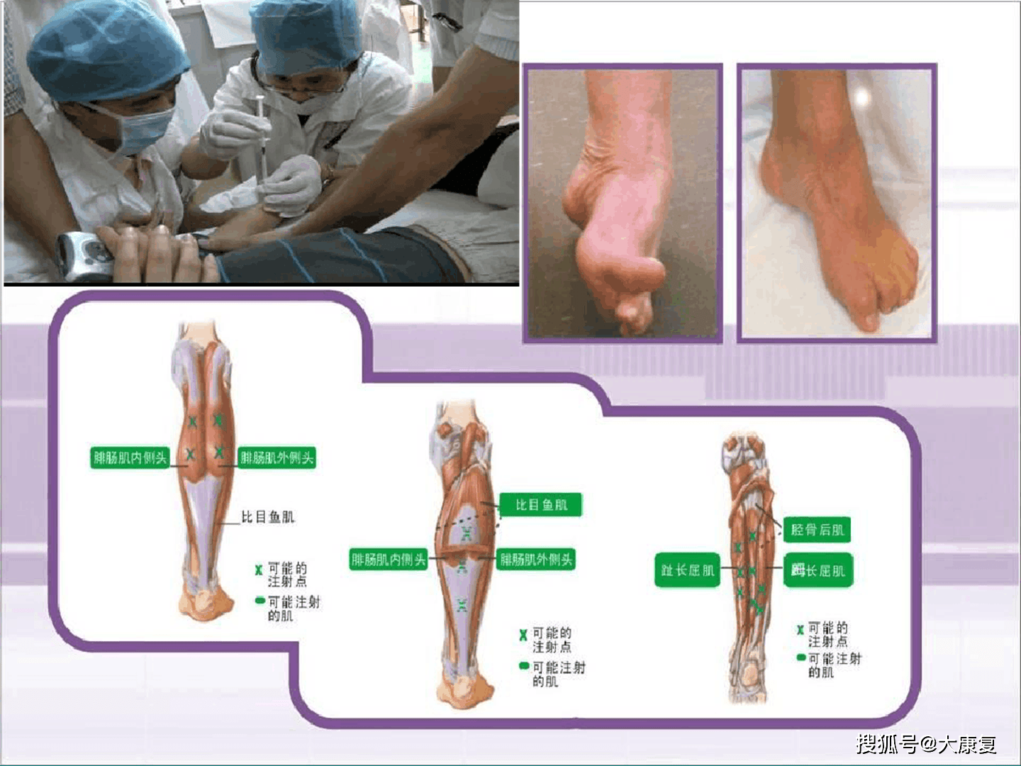 常见中枢性足下垂足内翻的处理策略