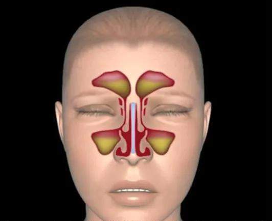 只知道鼻窦炎的可怕?可知道鼻窦的作用